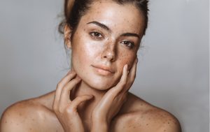 Como melhorar o aspecto do melasma na pele?