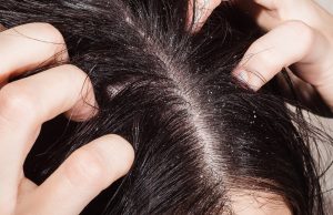 Como acabar com a caspa e evitar que ela volte