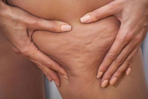 Como acabar com a celulite? 7 Dicas práticas