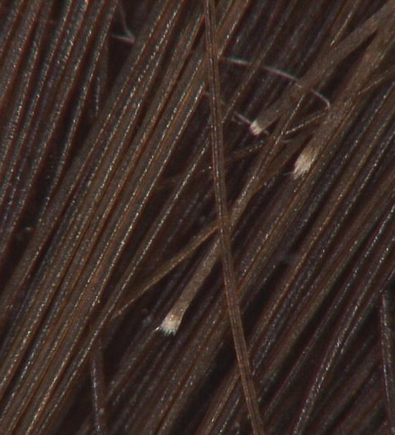 O que são aquelas Bolinhas Brancas ou Pontinhos Brancos que aparecem nos Cabelos?