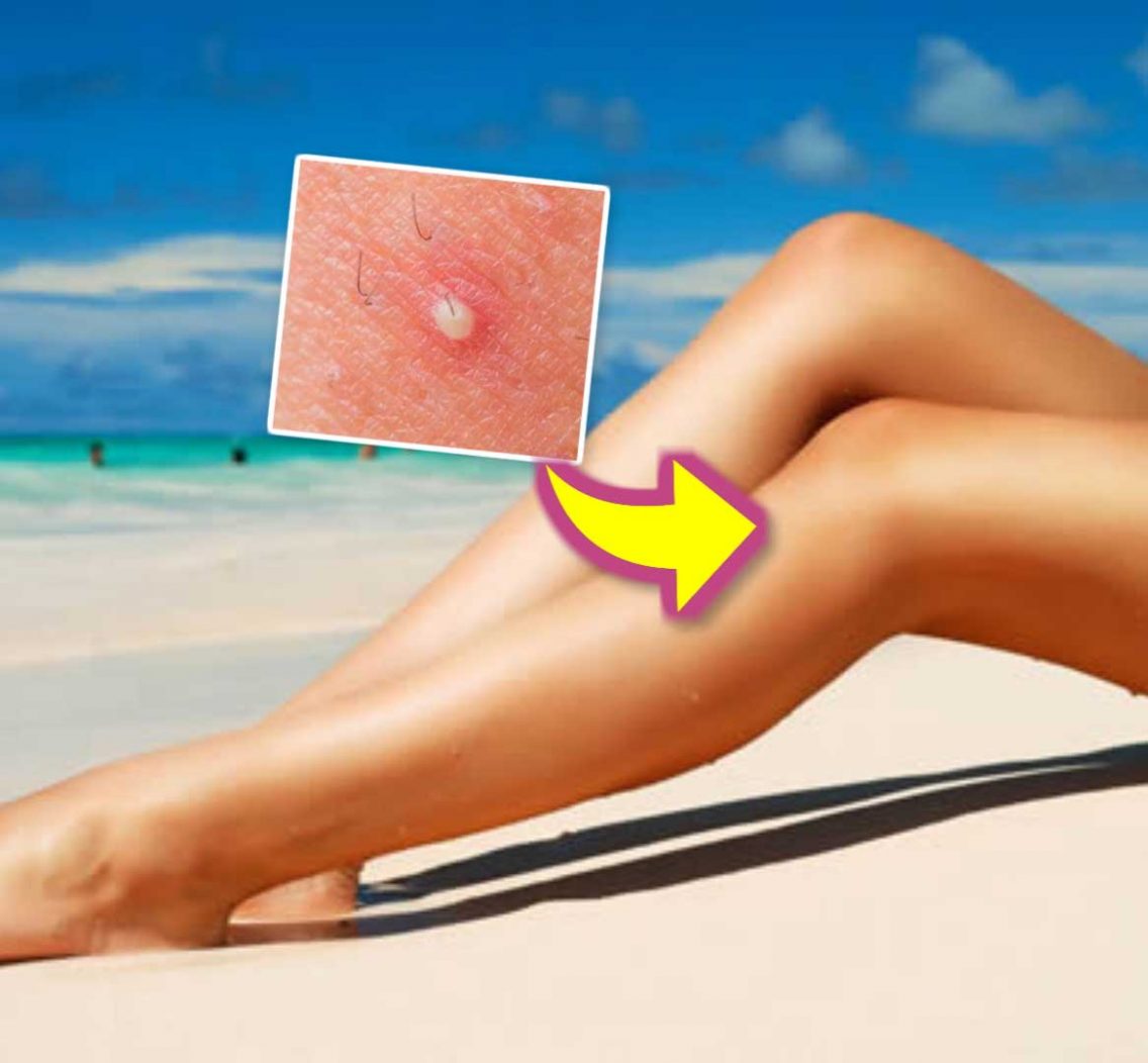 Como tratar e evitar a Foliculite: Dicas e Receitas Caseiras