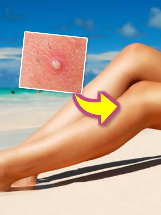 Como tratar e evitar a Foliculite: Dicas e Receitas Caseiras