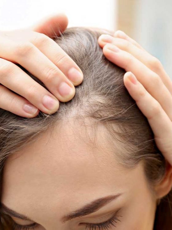 Qual a diferença entre Alopecia e Calvície?