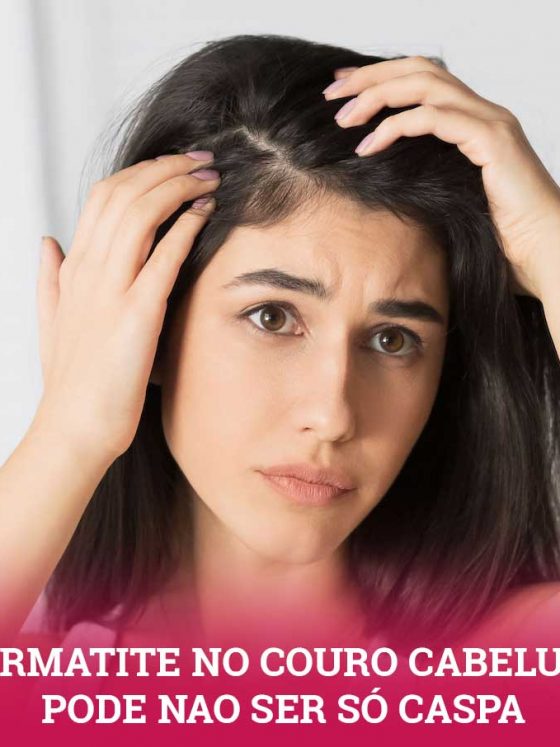 Dermatite no Couro Cabeludo pode não ser caspa (Dermatite Seborreica)