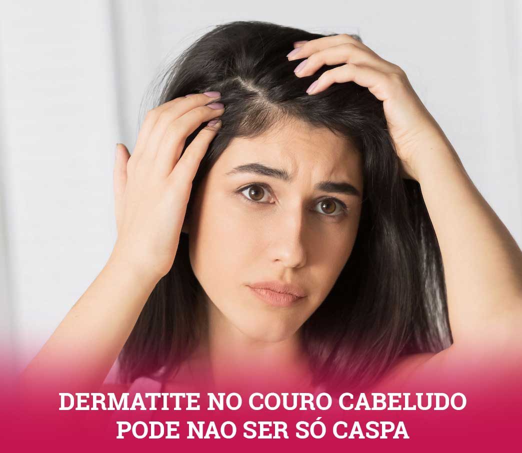 dermatite no couro cabeludo pode não ser caspa