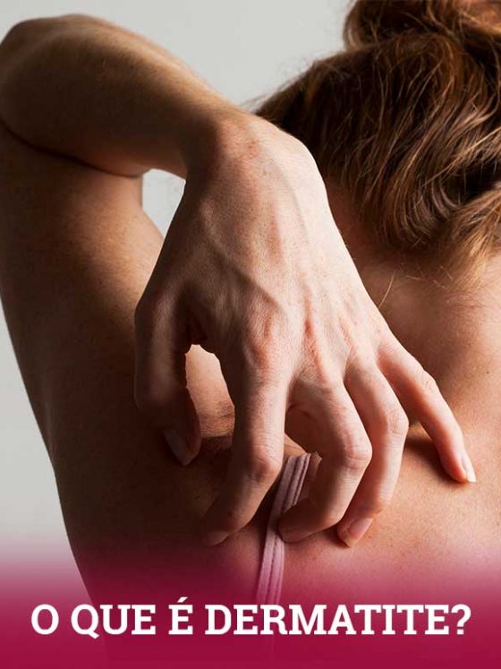 O que é dermatite? Entenda esse termo usado por quem ama cabelos e skincare