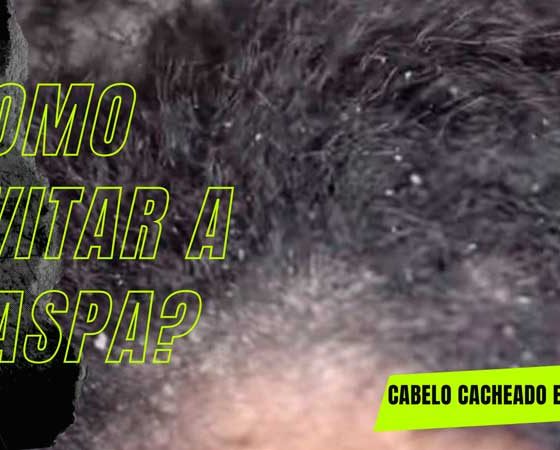 Como acabar com a caspa em cabelo cacheado e crespo? 3 dicas