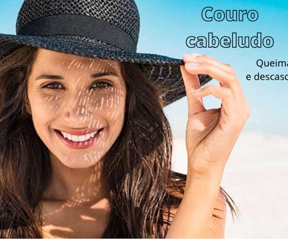 Couro cabeludo queimado de sol e fez casquinhas? 2 receitas caseiras contra descamação