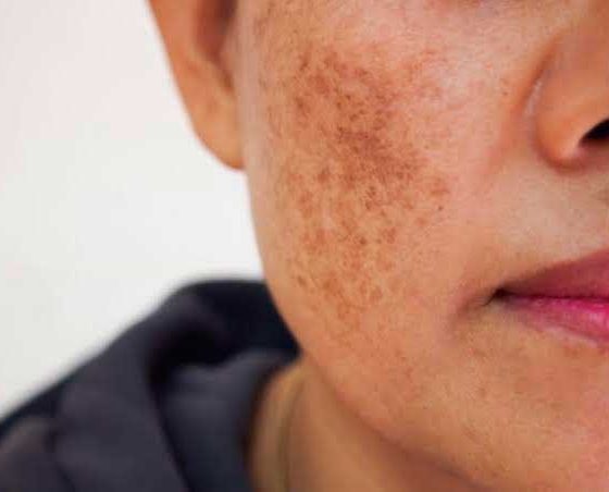 Como diminuir o melasma e manchas de sol na pele? 3 receitas caseiras