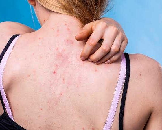 Espinhas nas costas e cravos? 3 dicas para ter a pele lisinha!