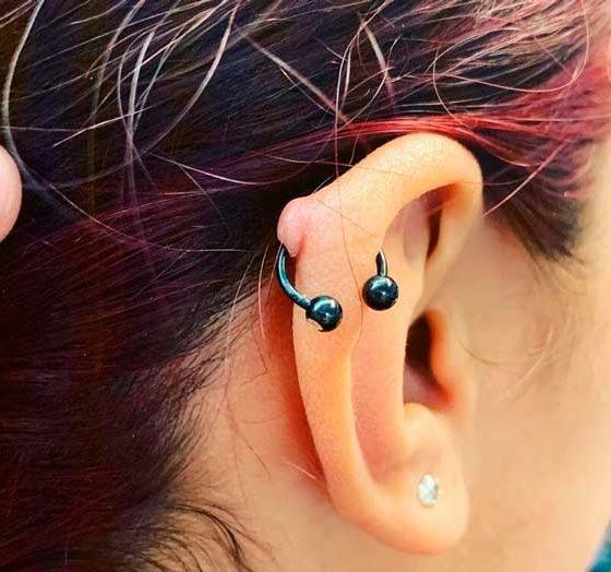 Como acabar com o queloide ou granuloma? Diferenças e 01 receita caseira