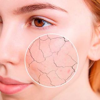 Como cuidar da pele no inverno e no frio? 4 dicas