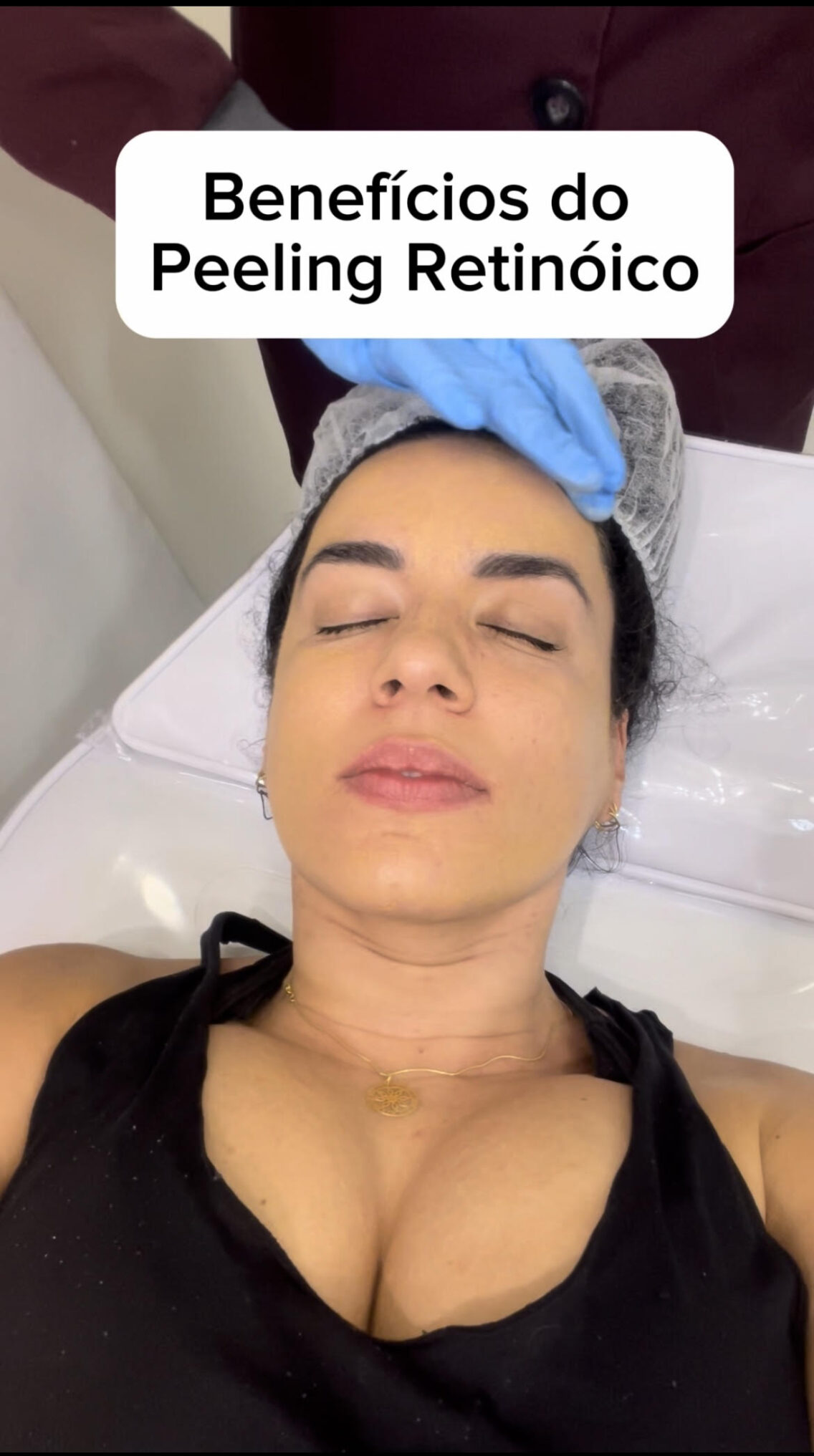 Peeling Retinóico Estimulador de Colágeno: contra poros dilatados, oleosidade, melasma, mancha e cicatriz de acne